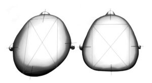 Tomado y modificado de Kreutz M, et al. Journal of Cranio-Maxillo-Facial Surgery 2018;46: 28e34